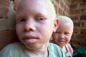 Enfants albinos En Tanzanie, où les croyances sur les pouvoirs magiques dus à l’albinisme persistent, meurtres et mutilations se sont intensifiées.