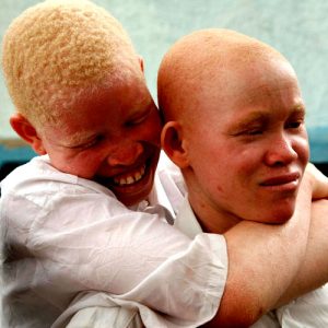 albinos-tanzanie On estime que plus de 150.000 albinos vivent en Tanzanie; un certain nombre d'albinos ont fui vers la région de Dar es Salaam (Maison de la Paix ou Havre de Paix) la plus grande ville de Tanzanie, parce qu’ils se sentent plus en sécurité dans un milieu urbain. On pense que la Tanzanie possède la plus grande population d'albinos en Afrique.